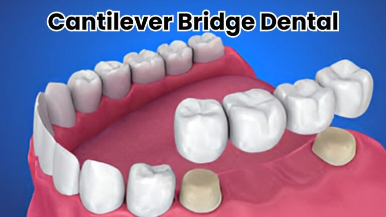 Cantilever Bridge Dental