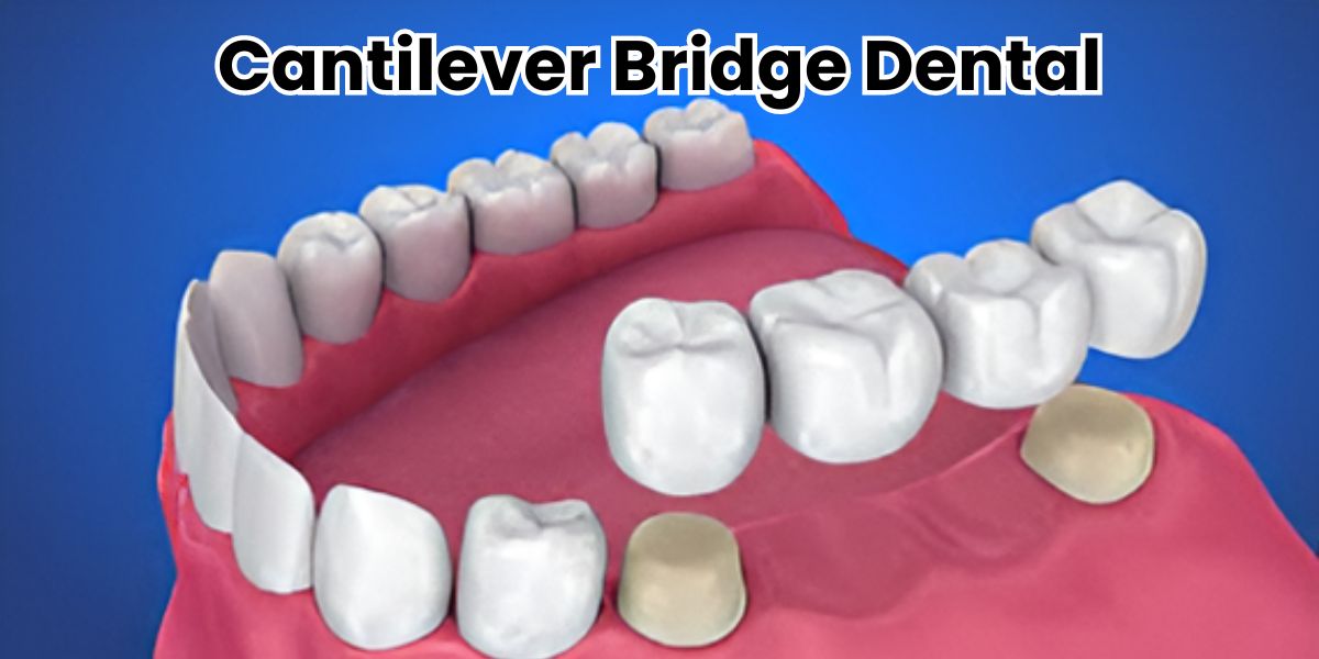 Cantilever Bridge Dental